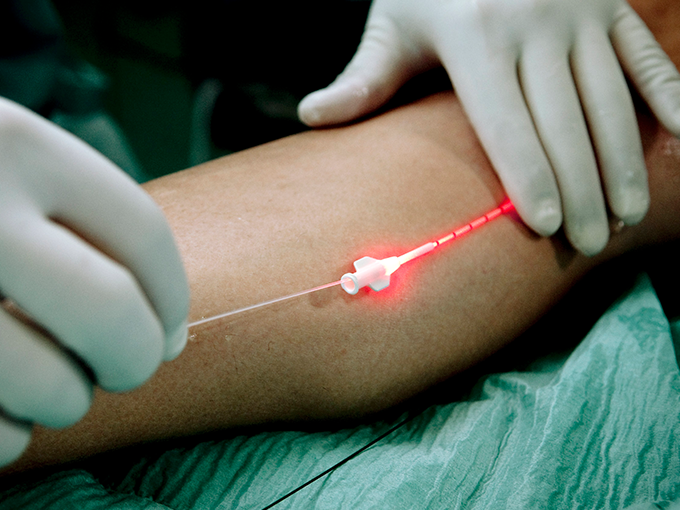 고주파 수술 요법