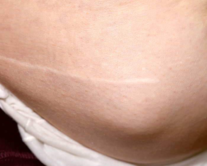 해피비뇨기과 탈장이란?